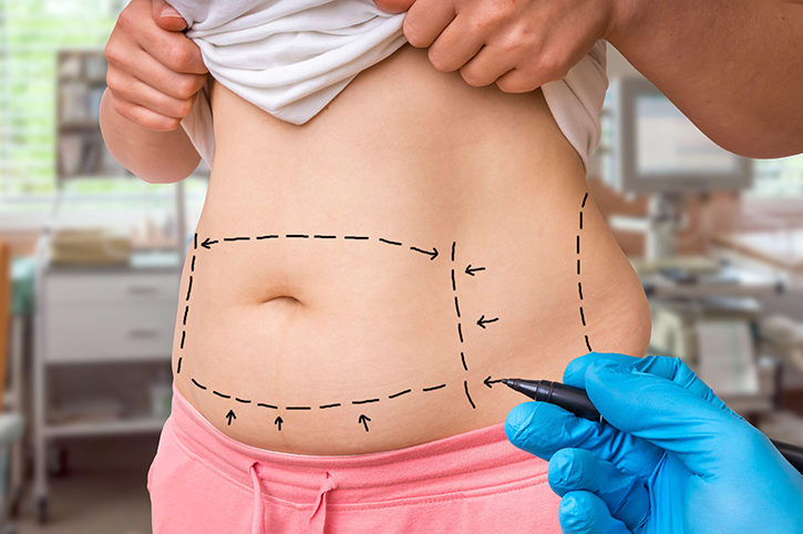 360 Liposuction